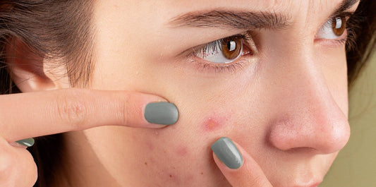 5 Effective Tips for Managing Adolescent Acne: Your Path to Clearer Skin